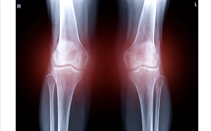 osteoartrosi del ginocchio