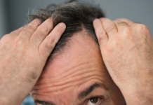 Alopecia androgenetica: evidenze cliniche su Serenoa repens e supporto nutrizionale alopecia androgenetica rimedi naturali serenoa repens