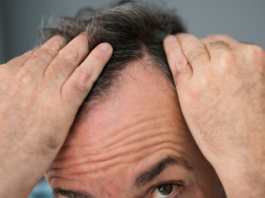 Alopecia androgenetica: evidenze cliniche su Serenoa repens e supporto nutrizionale alopecia androgenetica rimedi naturali serenoa repens