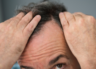 Alopecia androgenetica: evidenze cliniche su Serenoa repens e supporto nutrizionale alopecia androgenetica rimedi naturali serenoa repens