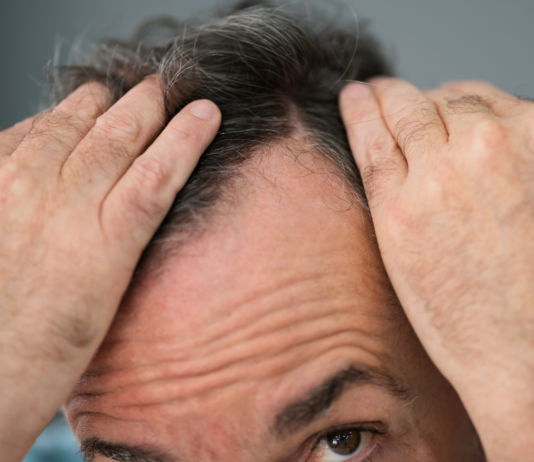 Alopecia androgenetica: evidenze cliniche su Serenoa repens e supporto nutrizionale alopecia androgenetica rimedi naturali serenoa repens