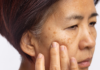 Melasma del viso: Cordyceps emerge come alternativa naturale sicura Cordyceps per il melasma