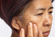 Melasma del viso: Cordyceps emerge come alternativa naturale sicura Cordyceps per il melasma