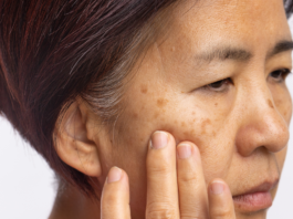 Melasma del viso: Cordyceps emerge come alternativa naturale sicura Cordyceps per il melasma