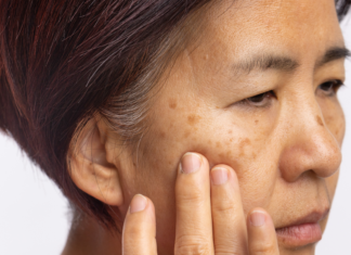 Melasma del viso: Cordyceps emerge come alternativa naturale sicura Cordyceps per il melasma