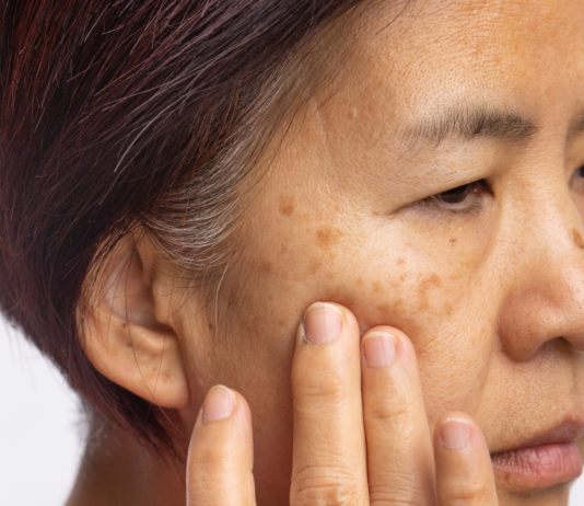Melasma del viso: Cordyceps emerge come alternativa naturale sicura Cordyceps per il melasma