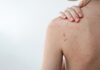 Acne e olio essenziale di Tea tree: le evidenze della ricerca scientifica Tea tree oil per il trattamento di acne