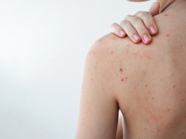 Acne e olio essenziale di Tea tree: le evidenze della ricerca scientifica Tea tree oil per il trattamento di acne