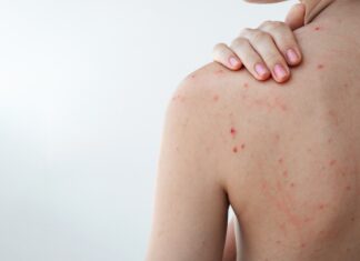 Acne e olio essenziale di Tea tree: le evidenze della ricerca scientifica Tea tree oil per il trattamento di acne