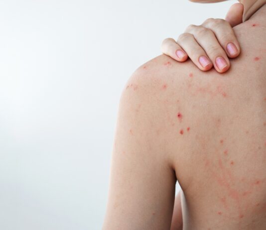 Acne e olio essenziale di Tea tree: le evidenze della ricerca scientifica Tea tree oil per il trattamento di acne