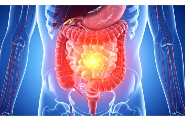 Intestino permeabile