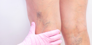 Malattia Venosa Cronica: diagnosi precoce, nutraceutici e approccio integrato malattia venosa cronica trattamento e prevenzione