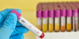 EBV: anticorpi monoclonali umani capaci di bloccare l’ingresso nei linfociti B Anticorpi monoclonali contro EBV
