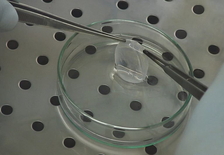 The first stem cell treatment approved in EU is made in Italy