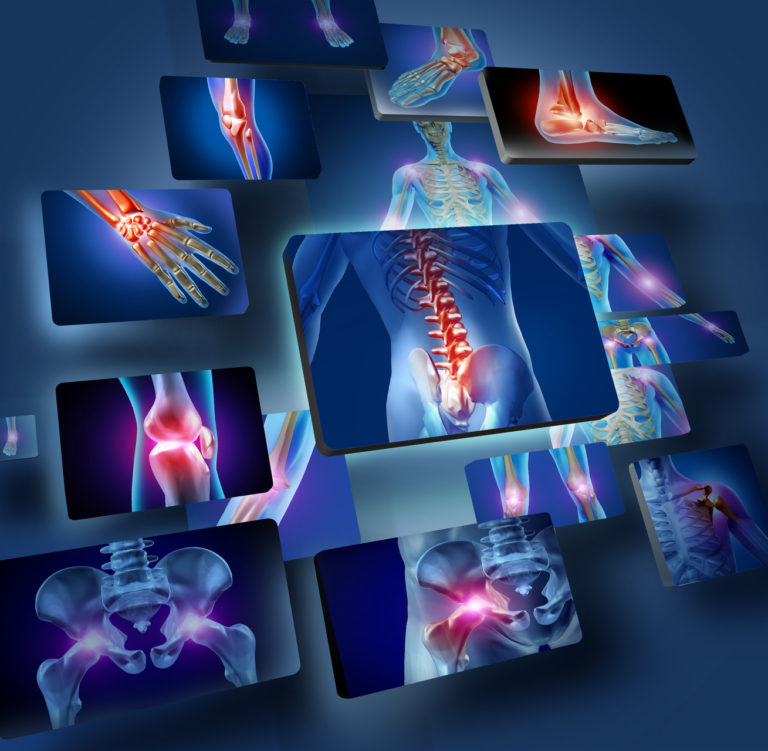 EMA approved tofacitinib for moderate to severe rheumatoid arthritis