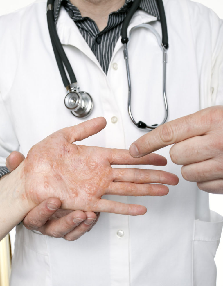 First biologic medicine approved for adults with moderate-to-severe atopic dermatitis