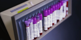 rFVIIIFc approvato in Europa per l’emofilia A