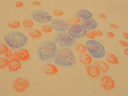 Blinatumomab per la leucemia linfoblastica acuta
