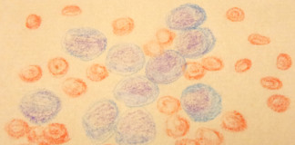 Leucemia linfoblastica acuta