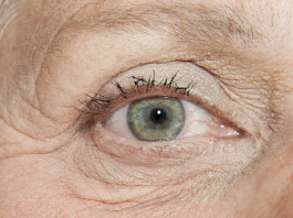 La maculopatia senile “vista” dai pazienti