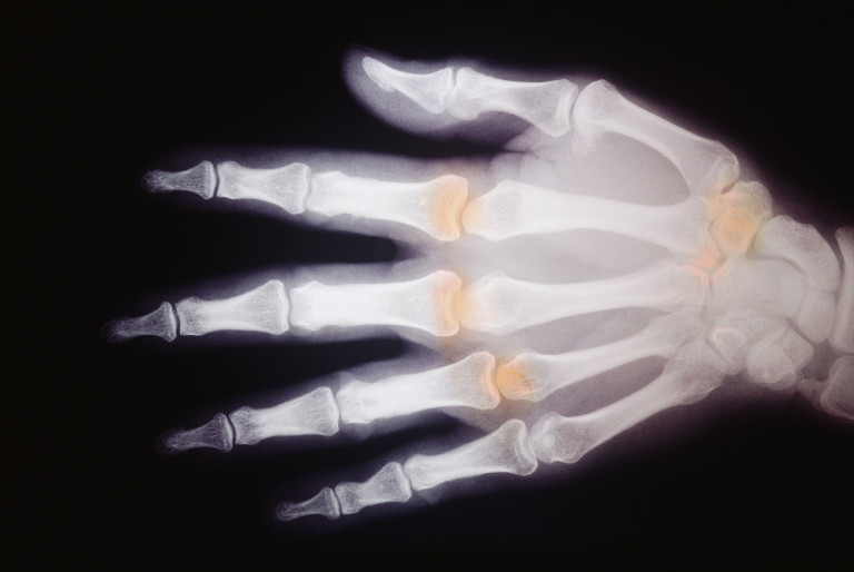 Sarilumab vs adalimumab per l’artrite reumatoide