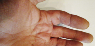 Collagenasi per il morbo di Dupuytren