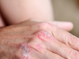 Secukinumab vs ustekinumab per la psoriasi