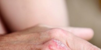 Secukinumab vs ustekinumab per la psoriasi