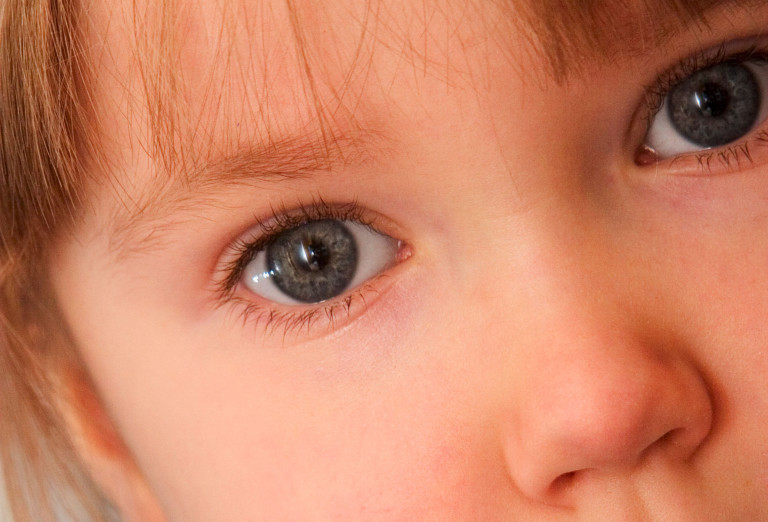 Cheratocongiuntivite vernal VKC