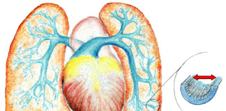 Riociguat per ipertensione polmonare