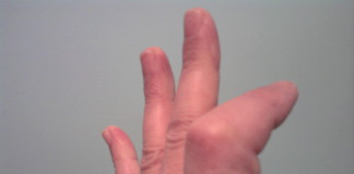 Collagenasi da Vibrio alginolyticus per la malattia di Dupuytren