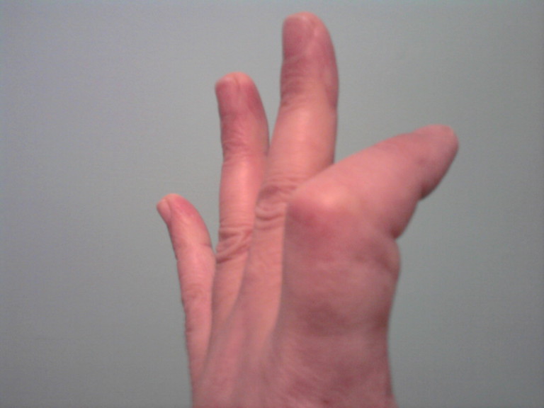 Collagenasi da Vibrio alginolyticus per la malattia di Dupuytren