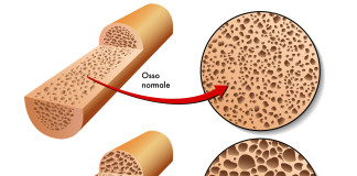Osteoporosi causata da farmaci