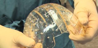 Stampa 3D di dispositivi medici impiantabili