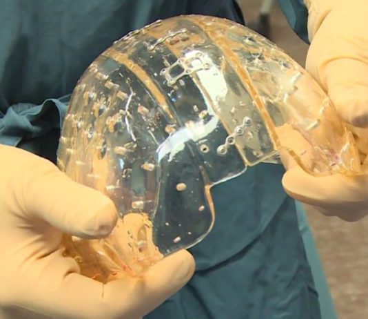 Stampa 3D di dispositivi medici impiantabili