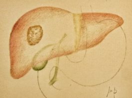 Regorafenib per il carcinoma epatocellulare