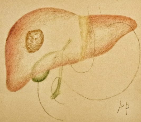 Regorafenib per il carcinoma epatocellulare
