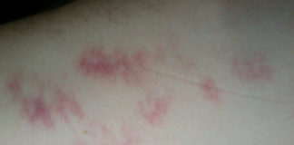 Dalbavancina per le infezioni batteriche degli epiteli