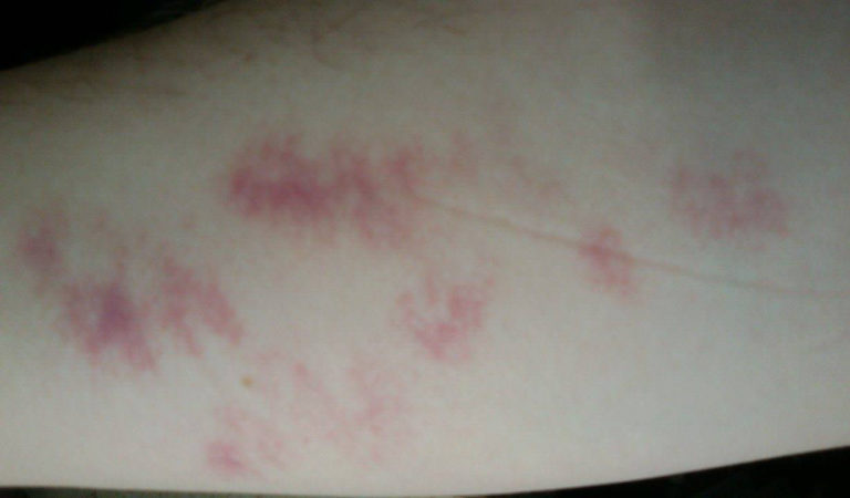 Dalbavancina per le infezioni batteriche degli epiteli