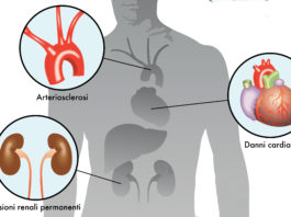 Empagliflozin riduce il rischio di nefropatia nel diabete di tipo 2