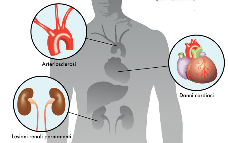 Empagliflozin riduce il rischio di nefropatia nel diabete di tipo 2