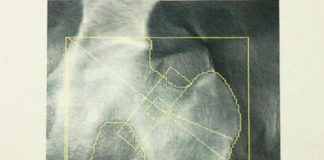 Rischio di fratture ossee, l’importanza dell’aderenza alla terapia