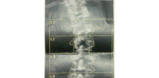 Vitamina D per prevenire le fratture ossee