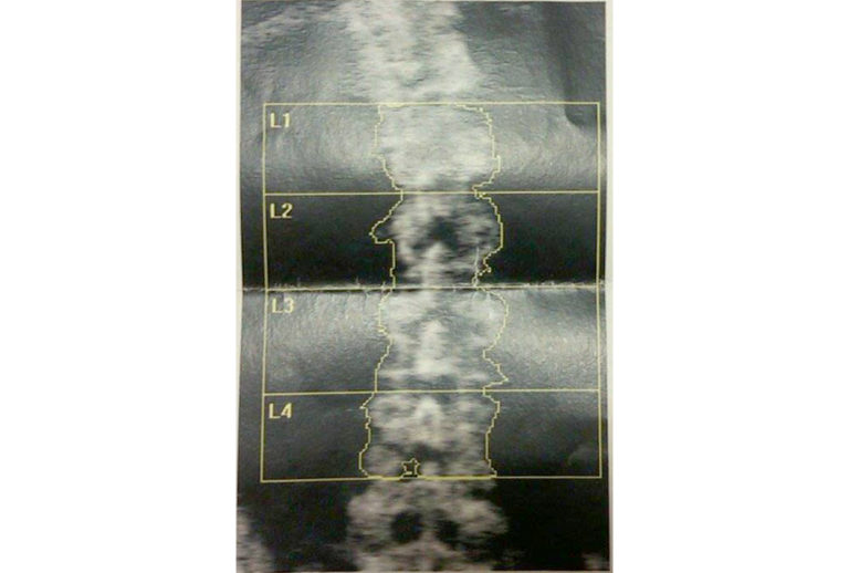 Vitamina D per prevenire le fratture ossee
