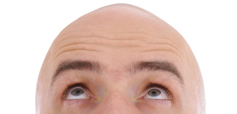 Alopecia, terapia con i fattori di crescita da staminali del tessuto adiposo