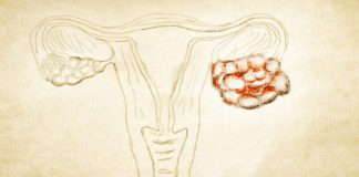 MiROvaR, modello prognostico per il tumore ovarico