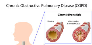 Corticosteroidi per via inalatoria nella terapia della BPCO