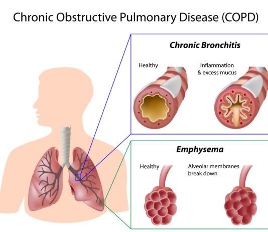 Corticosteroidi per via inalatoria nella terapia della BPCO