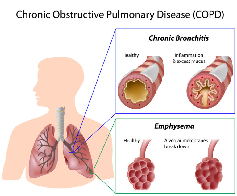 Corticosteroidi per via inalatoria nella terapia della BPCO