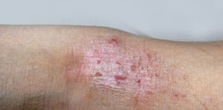 ClearSkin Lovers per sensibilizzare sulla psoriasi